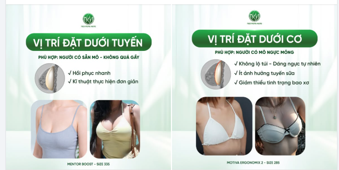 Đặt túi ngực dưới cơ hay dưới tuyến bác sĩ chỉ định dựa trên cơ sở nào?