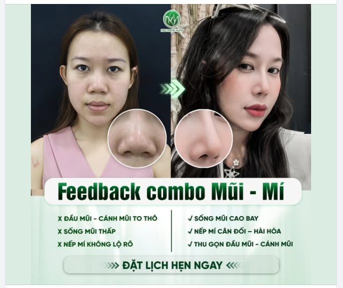 Em xinh say hi cùng combo mũi mí ưu đãi đến 18TR