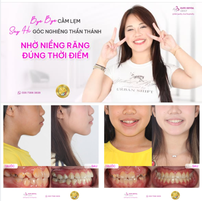 NIỀNG RĂNG SỚM CHO CON - KHÔNG CHỈ HẾT HÔ CÒN HẾT LẸM CẰM
