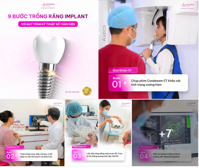 CÓ LẠI RĂNG MẤT AN TOÀN, NHANH CHÓNG VỚI TRỒNG RĂNG IMPLANT KỸ THUẬT SỐ
