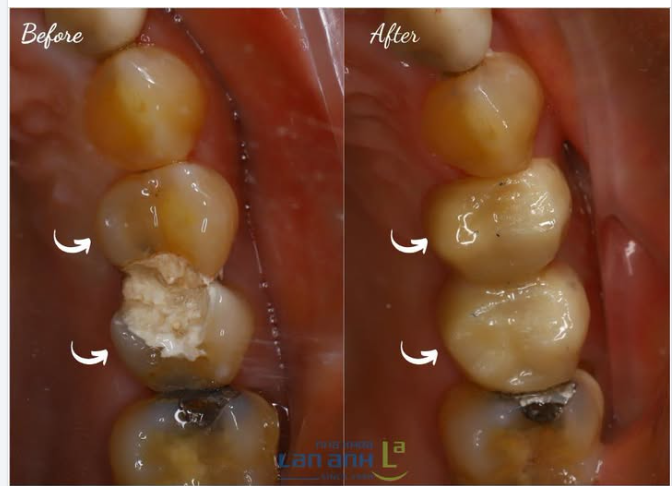Trước khi gặp bác sĩ:  Răng 24: "Tôi bị mẻ rồi, nhìn mất tự tin quá..."  Răng 25: "Tôi cũng chung cảnh ngộ đây..."  Cả hai cùng lo lắng về những ngày tháng ăn nhai khó khăn.