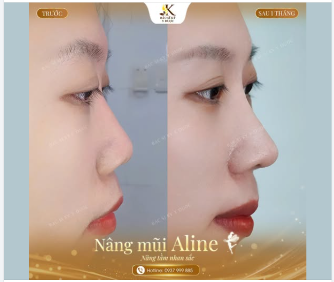 Cải thiện dáng mũi hếch  Tạo góc nghiêng thanh tú  Hài hòa ngũ quan, cân bằng phong thủy