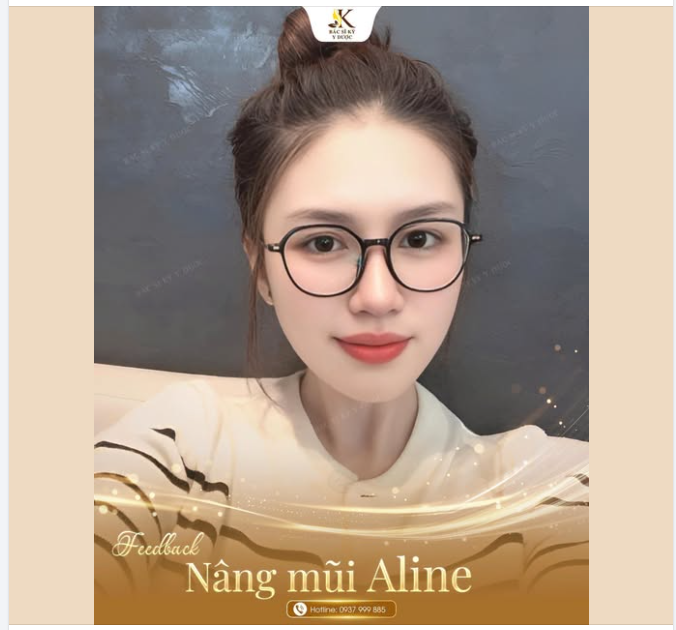 Nâng mũi bao lâu thì được đeo kính?