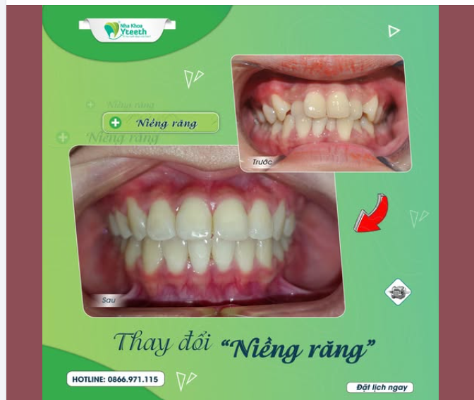 Niềng răng có cần nhổ răng không?