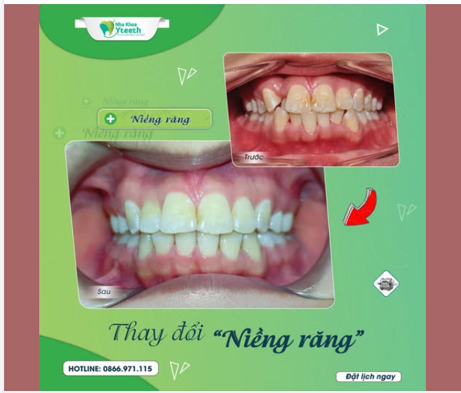 Thời gian niềng răng bao lâu?