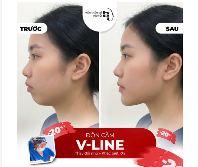 Độn cằm V-line là gì