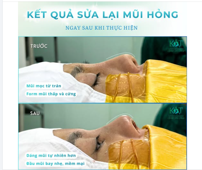 Khách sửa mũi hỏng thường chỉ tiếc một điều: “Giá như mình sửa sớm hơn.”