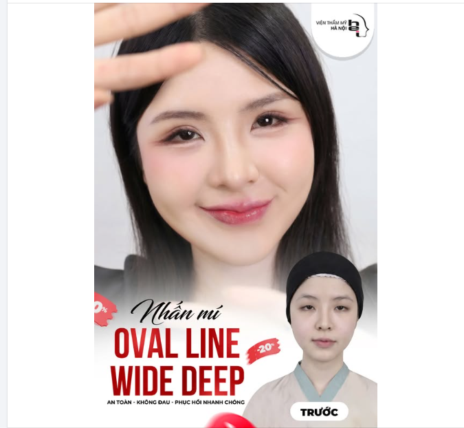 NHẤN MÍ OVAL LINE WIDE DEEP – MÍ ĐẸP CHUẨN TỶ LỆ VÀNG