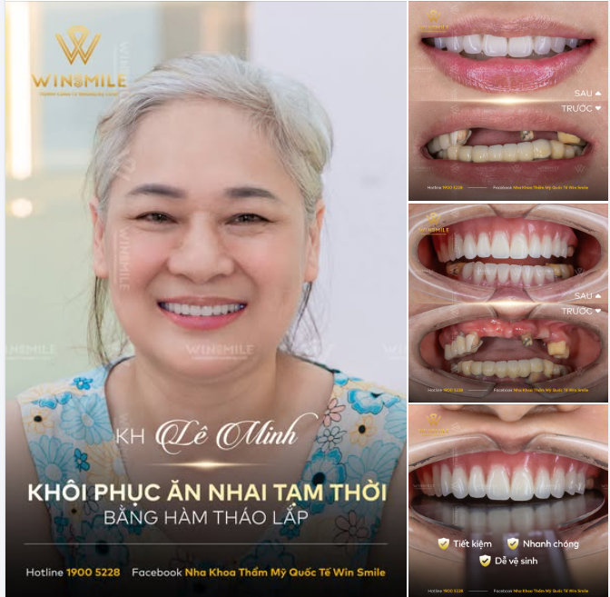 KHÔI PHỤC ĂN NHAI TẠM THỜI BẰNG HÀM THÁO LẮP