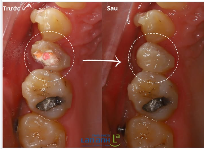 Trám sớm là tiết kiệm nhất.  Một lỗ sâu nhỏ có thể âm thầm lan rộng và phá hủy phần lớn thân răng.