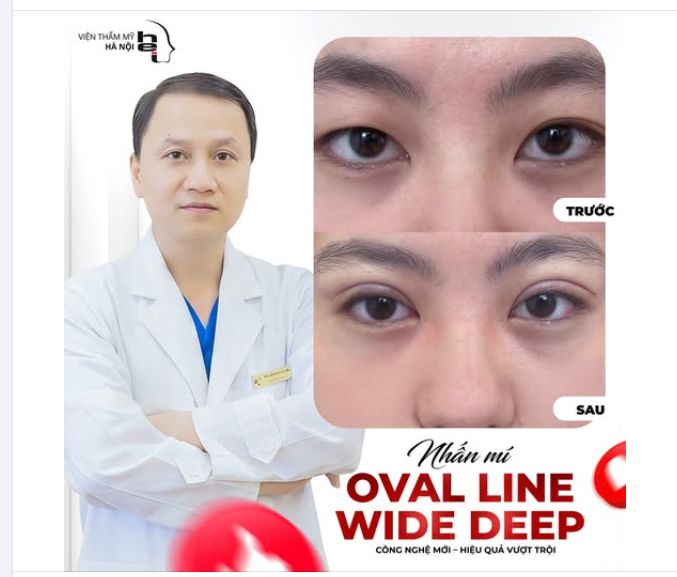 NHẤN MÍ OVAL – MẮT SÁNG NGỜI - RƯỚC TÀI LỘC