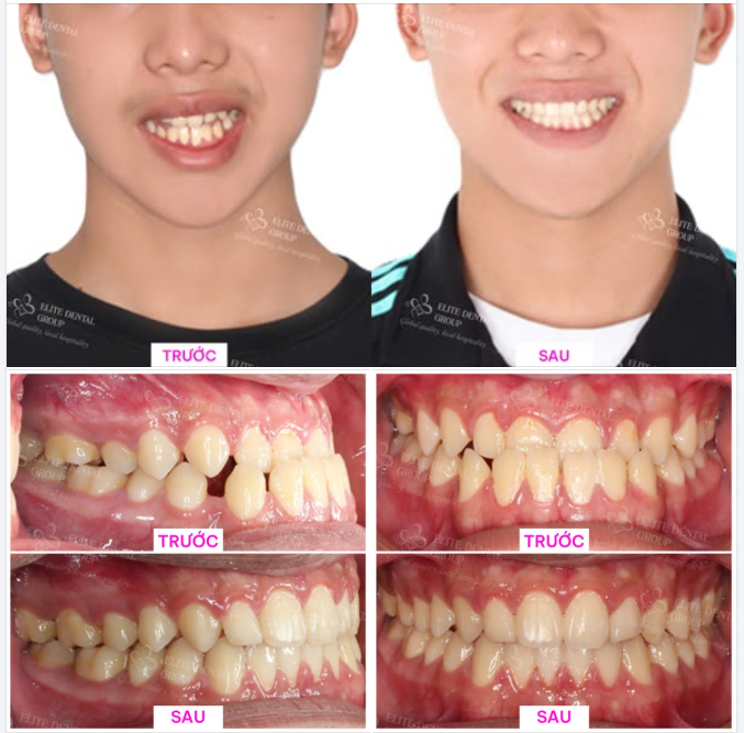 HẾT CẮN NGƯỢC LỆCH MẶT CHỈ SAU 2 NĂM NIỀNG RĂNG INVISALIGN
