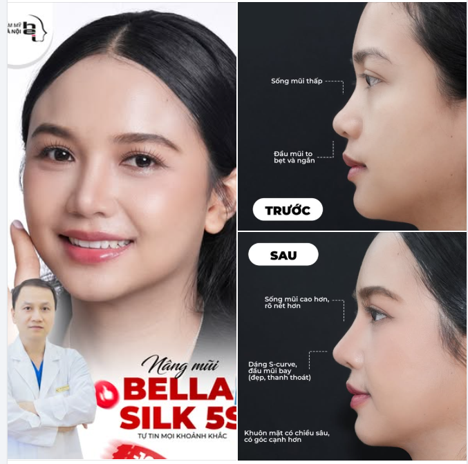 45 PHÚT NÂNG MŨI VÀ CÔNG NGHỆ 3D THAY ĐỔI ĐỊNH KIẾN "HÊN XUI" KHI ĐI LÀM ĐẸP!