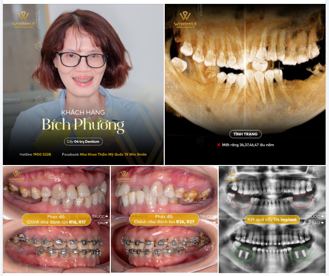 MẤT RĂNG LÂU NĂM, MUỐN TRỒNG IMPLANT ĐÔI KHI CẦN "ĐI ĐƯỜNG DÀI" HƠN
