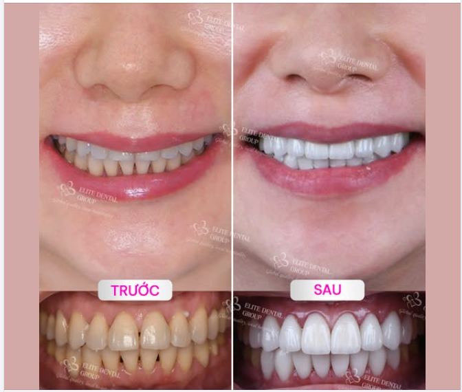 HOÀN THIỆN NỤ CƯỜI SAU CHỈNH NHA VỚI DÁN SỨ VENEERS