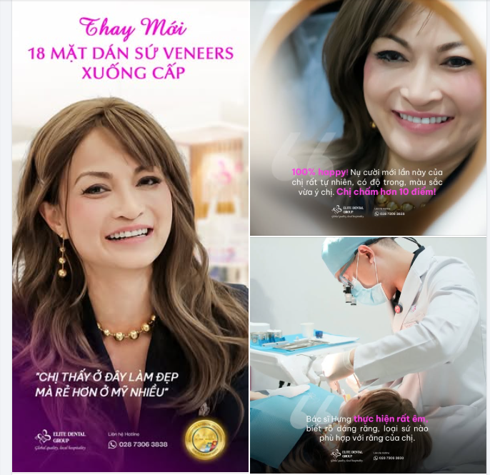 "HƠN 10 ĐIỂM!" ​​​​​​​ là cách chị Hằng Tuyết Swanson chấm cho nụ cười mới của mình sau khi dán sứ Veneers tại Elite Dental.