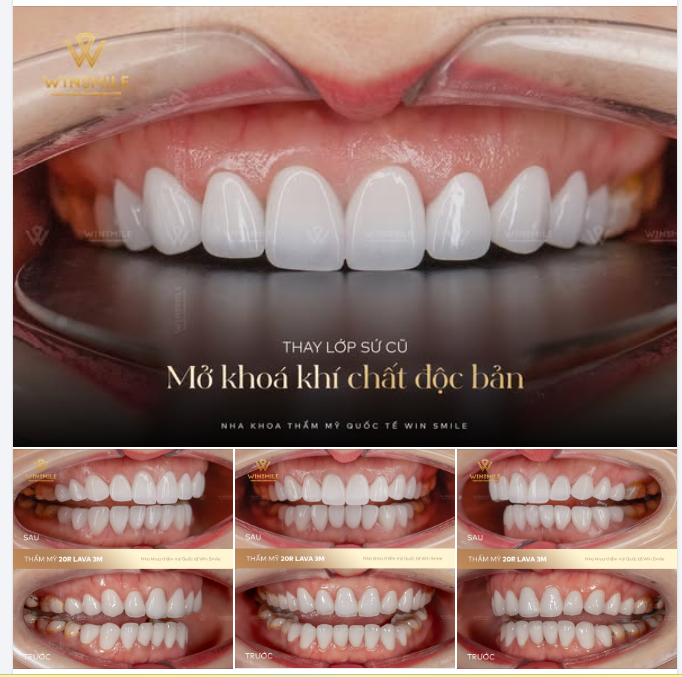 Một nụ cười đạt chuẩn cao cấp tại Win Smile phải là nụ cười mang đậm dấu ấn cá nhân và khơi gợi được thần thái tự nhiên nhất của người sở hữu