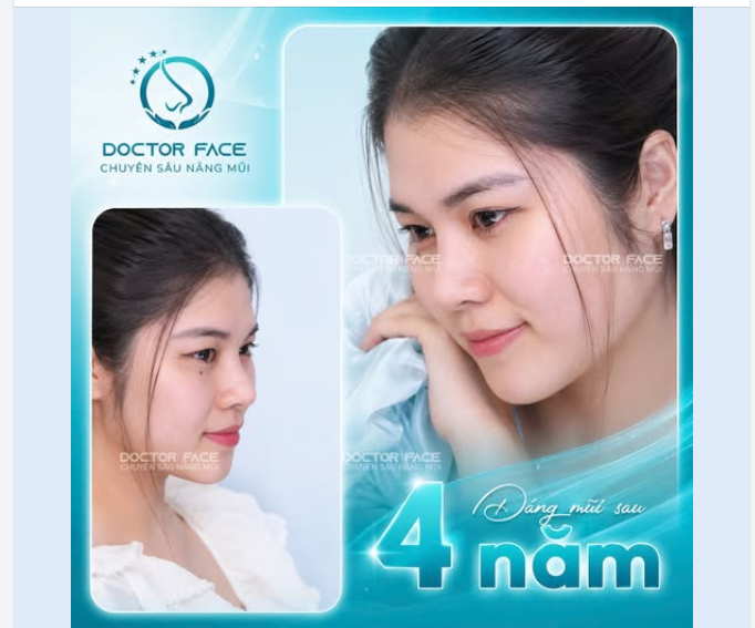 4 năm sau nâng mũi, điều khiến nhiều người yên tâm nhất không phải là dáng mũi đẹp, mà là vẫn đẹp như những ngày đầu
