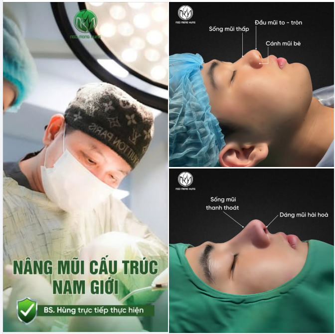 Nâng mũi cấu trúc nam giới – đẹp nhưng vẫn phải giữ nét nam tính