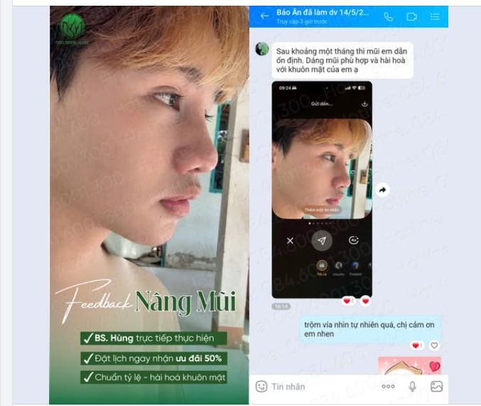 Feedback từ khách hàng Gen Z sau khi nâng mũi tại BV PTTM Ngô Mộng Hùng