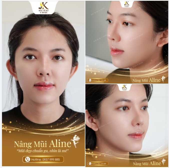 Nâng Mũi Aline  “Mũi đẹp chuẩn gu, nhìn là mê”