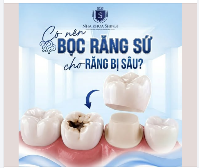 CÓ NÊN BỌC RĂNG SỨ CHO RĂNG BỊ SÂU?