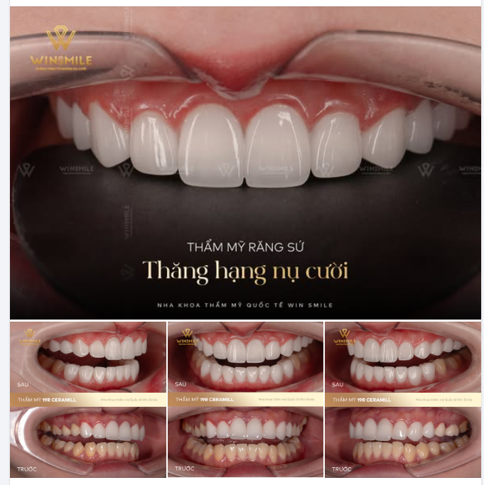 Một nụ cười đẹp chưa bao giờ nằm ở việc cố gắng làm cho thật trắng hay thật nổi bật một cách khiên cưỡng, mà nằm ở sự vừa vặn với chính tổng thể gương mặt