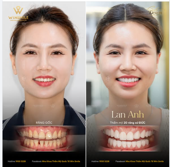 Món quà lớn nhất mà Win Smile nhận được sau mỗi ca điều trị, đôi khi chỉ đơn giản là ánh mắt ngập tràn hạnh phúc của khách hàng khi ngắm mình trong gương.