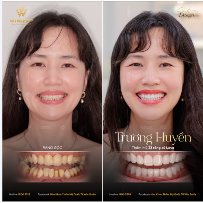 Với Win Smile, một nụ cười đẹp chưa bao giờ là sự thay đổi hoàn toàn để biến thành một ai khác, mà là giúp người phụ nữ rạng rỡ hơn đúng với thần thái vốn có của chính mình