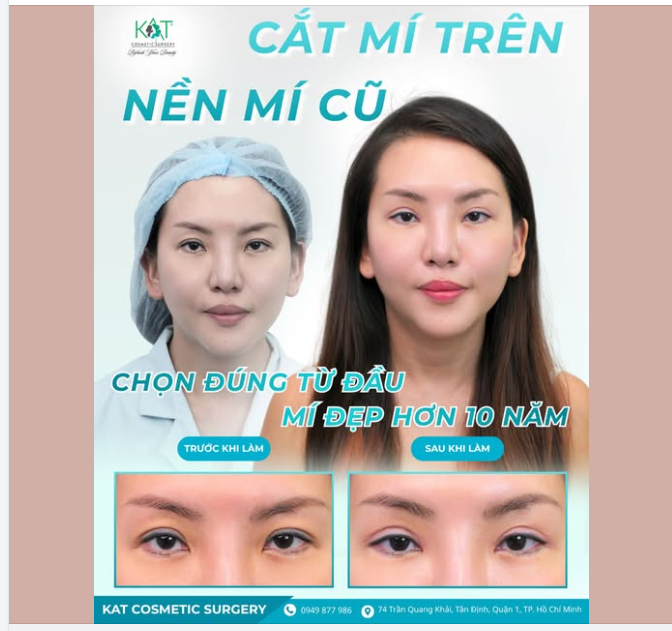 Hơn 10 năm trước, chị chọn KAT để cắt mí.