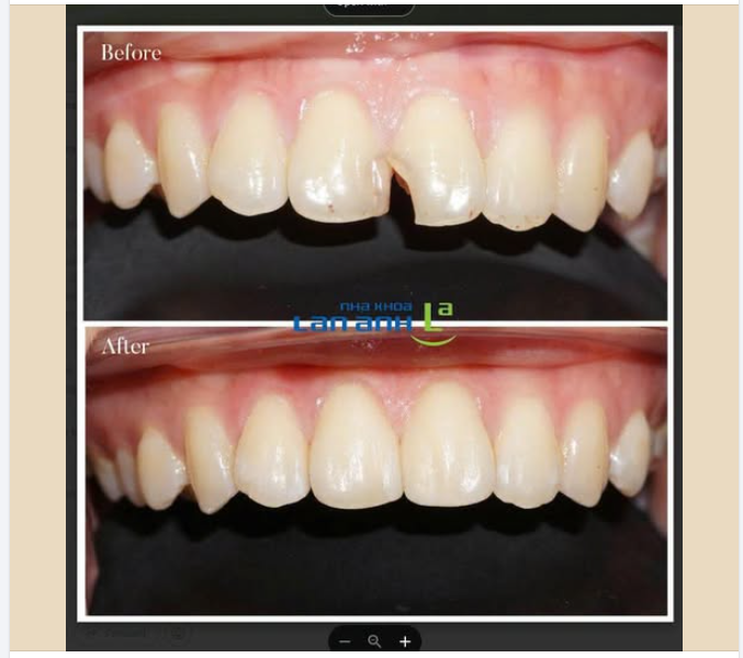 Mẻ răng cửa nhỏ: Trám thẩm mỹ có đủ bền không?  Không phải trường hợp nào cũng cần bọc sứ.