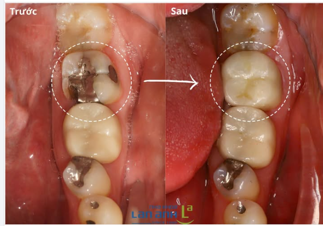 Không phải miếng trám nào cũng có thể đồng hành mãi với chiếc răng.