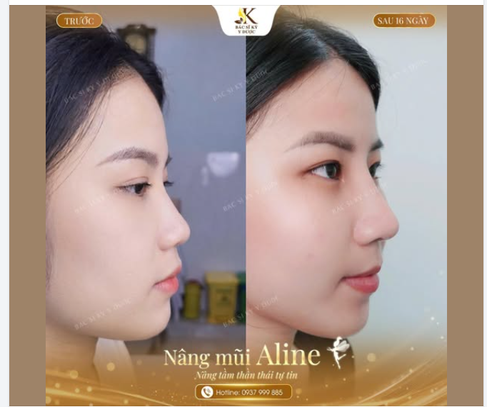 Thay đổi cả gương mặt nhờ dáng mũi cao