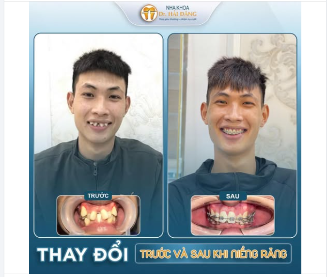 TRƯỚC VÀ SAU NIỀNG RĂNG - KHÁC BIỆT THẤY NGAY TỪ NỤ CƯỜI