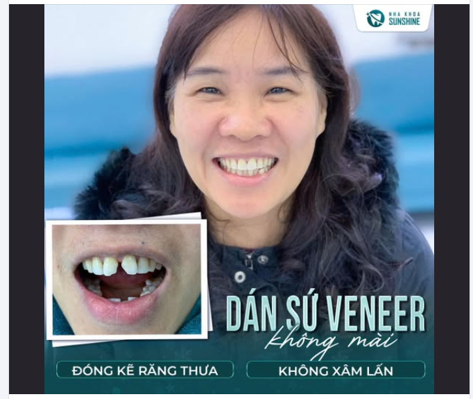 Khép khoảng thưa – Giữ trọn răng thật với dán sứ Veneer không mài