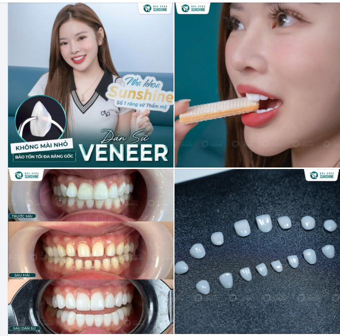 DÁN SỨ VENEER KHÔNG MÀI – ĐẸP TỰ NHIÊN, GIỮ TRỌN RĂNG THẬT