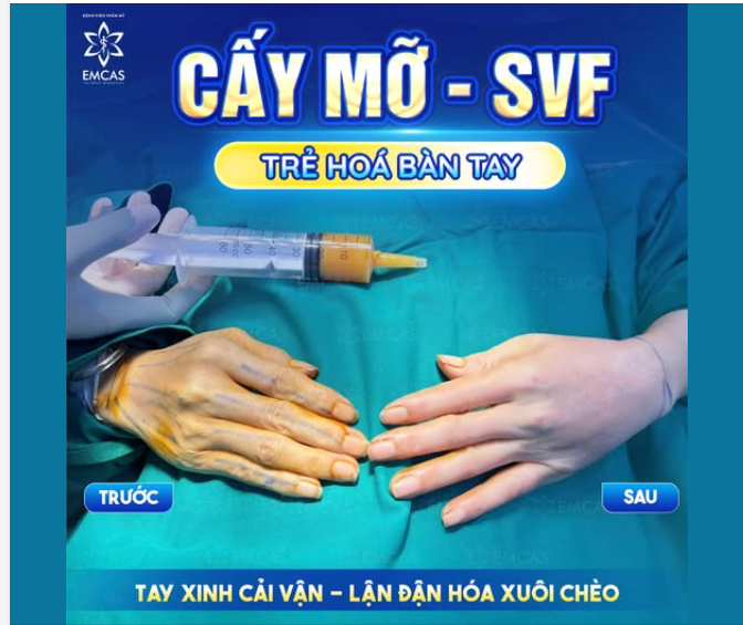 TRẺ HÓA BÀN TAY BẰNG MỠ TỰ THÂN VÀ SVF
