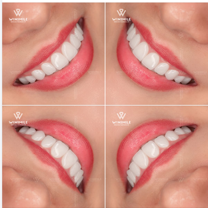 Mong muốn sở hữu một nụ cười đẹp theo cách tinh tế, nhẹ nhàng và phù hợp với chính mình, chị khách hàng đã lựa chọn Win Smile để gửi gắm hành trình thay đổi ấy.