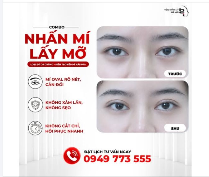 NHẤN MÍ OVAL LINE WIDE DEEP – MẮT SANG CHẢNH, QUYẾN RŨ