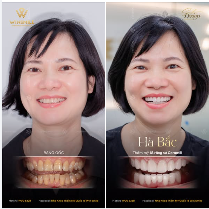 Giữa những tiêu chuẩn thẩm mỹ đại trà, Win Smile chọn cùng khách hàng tạo nên một phiên bản độc bản, tôn lên nét đẹp riêng của mỗi khách hàng.