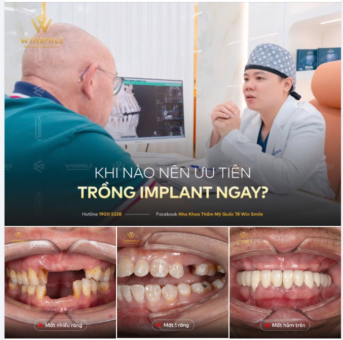 MẤT RĂNG RỒI!! KHI NÀO NÊN ƯU TIÊN TRỒNG IMPLANT NGAY?