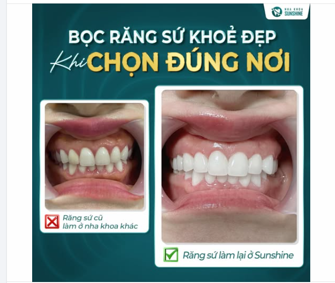 HỐI HẬN VÌ KHÔNG BIẾT ĐẾN SUNSHINE SỚM HƠN ​​​​​​​ HẬU QUẢ KHI LỰA CHỌN NHA KHOA KHÔNG UY TÍN.