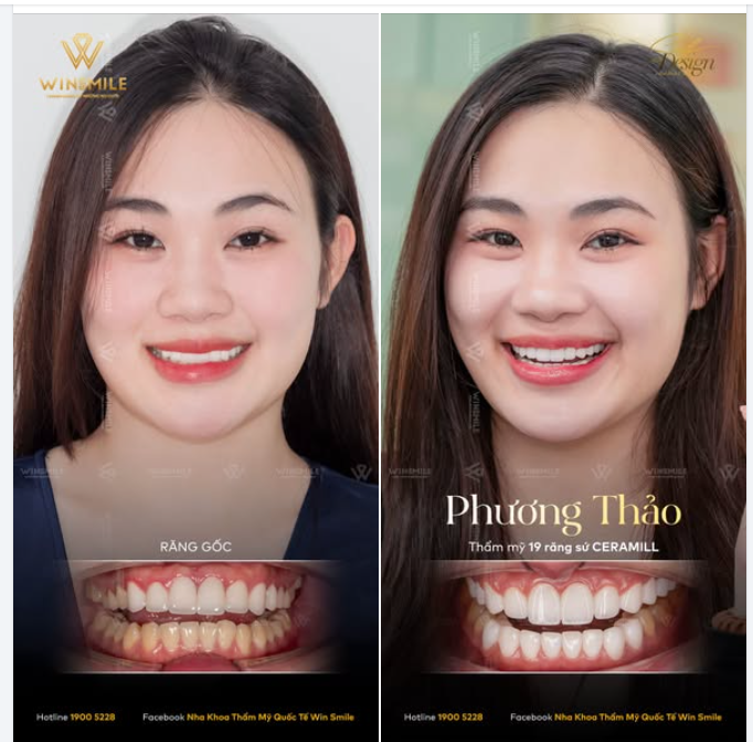 THẦN THÁI RẠNG RỠ - THƯỚC ĐO HOÀN HẢO CỦA THẨM MỸ NỤ CƯỜI