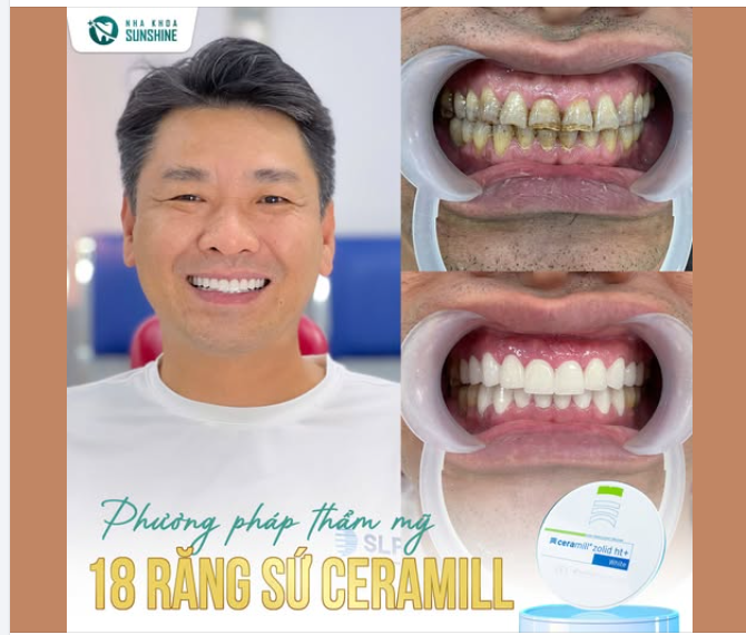 Trong những dòng sứ được nhiều khách hàng quan tâm, Celamill luôn là cái tên được đánh giá cao nhờ sự cân bằng giữa chất lượng, tính thẩm mỹ và chi phí.