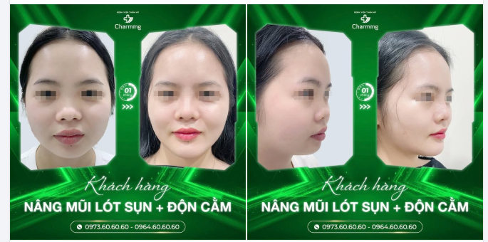 NÂNG MŨI + ĐỘN CẰM – “COMBO BẤT BẠI” CHO GÓC NGHIÊNG THĂNG HẠNG