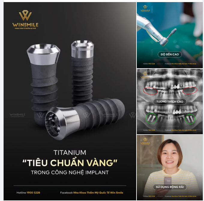 Titanium - "Tiêu Chuẩn Vàng" trong công nghệ trồng răng Implant