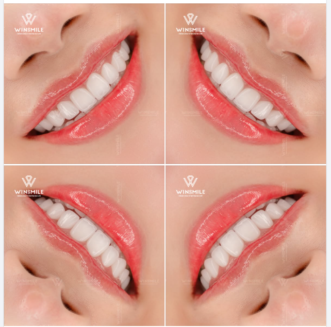 Bạn có bao giờ nhìn sâu vào một nụ cười và cảm thấy bị thu hút bởi những điều rất nhỏ?