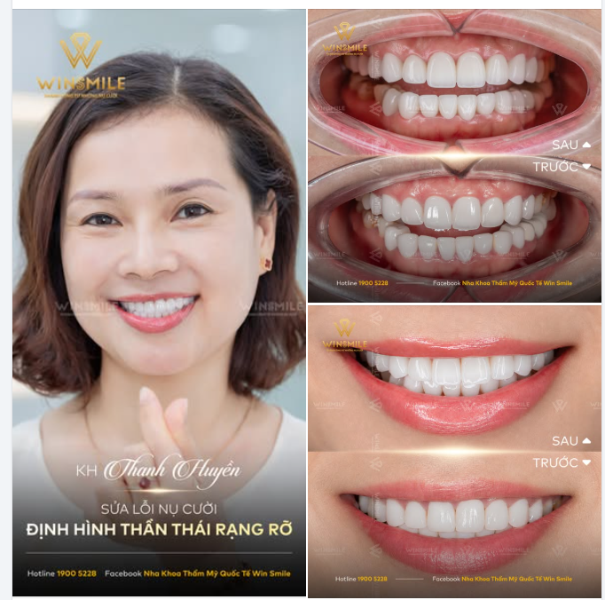 Sau những giờ đồng hồ cùng chuyên gia Bùi Bích Uyên lắng nghe và phân tích, nụ cười trong mơ của chị Huyền đã thực sự được tái sinh - một nụ cười không chỉ chuẩn tỷ lệ mà còn định hình chuẩn xác thần thái rạng rỡ: