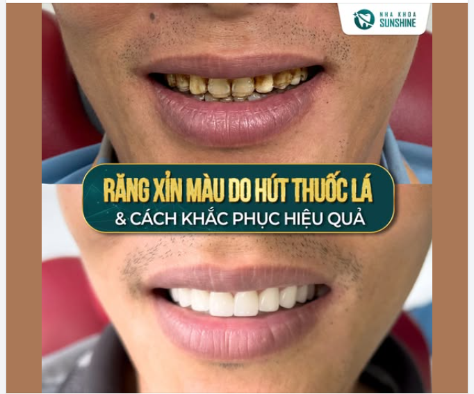 Có những khách hàng sở hữu hàm răng khá đều, nhưng vẫn chưa tự tin vì men răng sỉn màu và xuống cấp theo thời gian.