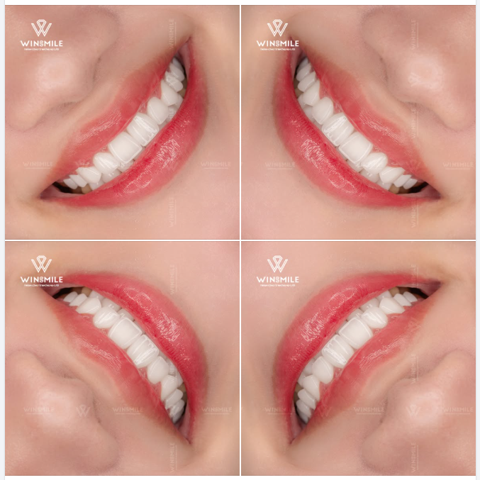 Đỉnh cao của thẩm mỹ nụ cười hiện đại nằm ở khả năng tạo ra những điểm chạm cân bằng đầy chủ ý, nơi dáng răng hoà hợp hoàn hảo với cá tính độc bản của người sở hữu